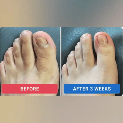 FungaCure™ – Nail Repair Patches